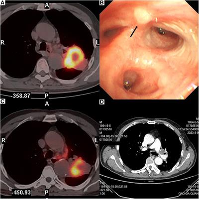Case Report: Uniportal robot-assisted thoracoscopic double-sleeve lobectomy after neoadjuvant immunotherapy